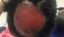 Tai nạn nghiêm trọng khi uốn tóc: Tóc cuốn vào ống dẫn nhiệt, nữ bác sĩ bỏng sâu, tróc gần như toàn bộ da đầu