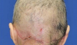 Bị lột sạch da đầu vì tóc quấn vào máy dệt sợi công suất lớn