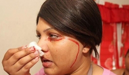 Hội chứng kỳ lạ khiến người ra “mồ hôi máu” liên tục