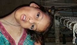 Xót xa cuộc đời bé gái 9 tuổi đầu cổ luôn cong vẹo 90 độ đến mức không đi được