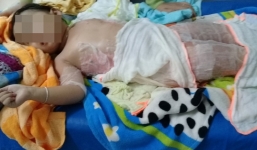 Bé 3 tuổi ngã vào nồi chè khi đi dự tiệc nhà hàng, toàn thân bỏng nặng
