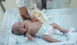TP.HCM: Vừa chào đời, bé gái đã mang khối u khủng trên cơ thể khiến tính mạng nguy hiểm