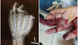 Nam thanh niên mất tay vì chơi pháo trong lễ hội