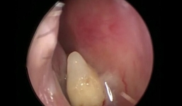 Kỳ lạ chuyện răng mọc trong mũi gây chảy máu cam suốt hàng chục năm