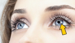 Có thể bị mù vĩnh viễn nếu mắt có dấu hiệu này mà mặc kệ không đi khám