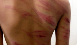 Cha dượng đánh con riêng của vợ bầm tím khắp người