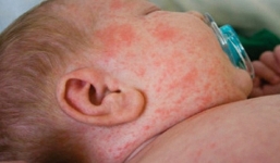 Ca tử vong vì bệnh sởi đầu tiên tại Hà Nội: Chưa đến tuổi tiêm phòng đã mắc bệnh