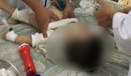 Cảnh báo: Bệnh nhi 11 tháng tuổi tử vong thương tâm do nuốt bóng bay