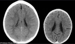 Ảnh chụp CT não của 2 em bé khác nhau khiến bố mẹ giật mình về cách dạy con