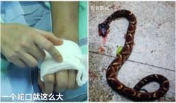 Người phụ nữ bị rắn độc cắn suýt mất mạng chỉ vì tò mò... xem làm thịt rắn