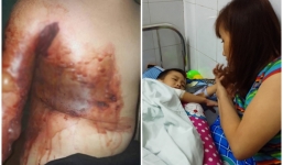 Nghịch dại bé 5 tuổi bỏng nặng, mẹ thiếu tiền đành cho con xuất viện sớm để dùng thuốc nam khiến con bị hoại tử
