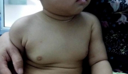 Bé gái 2 tuổi ngực to như 18 tuổi vì 'ăn thuốc tránh thai' của mẹ