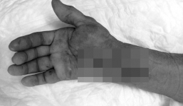 Người phụ nữ bị thối rữa cổ tay vì nghe lời 'lang băm' tiêm thuốc trị nhức mỏi