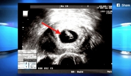 Mẹ yêu cầu siêu âm trước khi nạo hút thai và bác sĩ đã phát hiện điều kỳ diệu