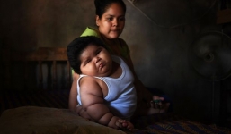 Mắc bệnh đặc biệt khiến cậu bé nặng 28 kg khi mới 10 tháng tuổi