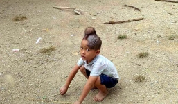 Bé trai 5 tuổi có khối u kì dị mọc trên đỉnh đầu, bố mẹ quá nghèo chờ mãi mới đưa con đi khám