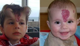 Bé trai chấp nhận 'mọc sừng' để tẩy vết bớt trên mặt