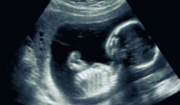 Người phụ nữ mang thai đôi nhưng cặp song sinh khác cả bố lẫn mẹ