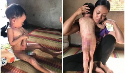 Xót xa cảnh bé gái 3 tuổi dân tộc Chơ Ro vừa sinh ra đã bị lở loét khắp người