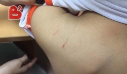 Hà Nội: Xôn xao việc giáo viên mầm non đánh con riêng của chồng thâm tím cơ thể