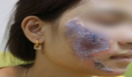 Hà Nội: Dùng kem trộn, một phụ nữ bị 'lột sạch' da mặt, mất hàng trăm triệu điều trị nhưng chỉ phục hồi được 30-40\%