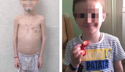 Để lấy trợ cấp cho trẻ tàn tật, mẹ nuôi nhẫn tâm bạo hành con trai tàn độc