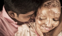 Mặt biến dạng vì axit, cô gái vẫn khiến một anh chàng mê mệt, tình nguyện chăm sóc cả đời