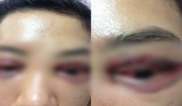 Cộng đồng mạng xôn xao hình ảnh đôi mắt của cô gái 'biến dạng' vì nhấn mí hỏng