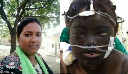 Vợ bị chồng tạt axit cháy xém mặt 