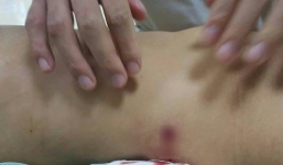 Hà Nội: Đang đi trên đường, cô gái bị đạn bắn trúng người