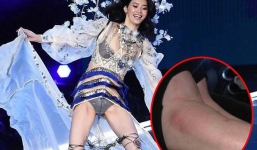 Lộ ảnh cổ chân sưng to, tấy đỏ của Ming Xi sau cú ngã 'trời giáng' tại Victorias Secret Fashion Show