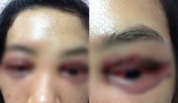 Chủ spa bị tố cắt mí mắt hỏng cho khách tắt điện thoại, dọn đi trước khi đoàn kiểm tra đến