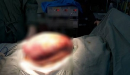 Phẫu thuật khối u khổng lồ nặng hơn 5kg cứu sống bệnh nhân