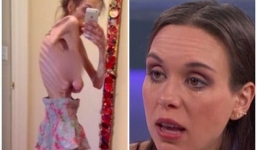 Mắc chứng bệnh lạ, cô gái 28 tuổi bị gọi là 'bộ xương di động' nhiều lần suýt bỏ mạng vì quá gầy