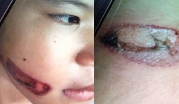 Cách ly bé gái 7 tuổi bị dí sắt nung vào mặt khỏi cha ruột và mẹ kế