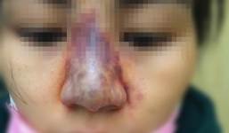 Tiêm chất làm đầy trúng tĩnh mạch, cô gái trẻ suýt bị hoại tử mũi