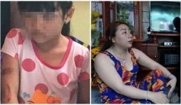 Bé gái bị dí sắt nung vào mặt: Cha và mẹ kế lý giải vết thương do... bỏng