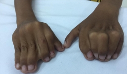 Quà giáng sinh đến sớm với cậu bé không thể đến trường vì “đôi bàn tay ếch” kỳ dị