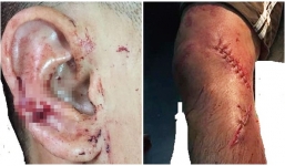 Chồng nhậu say bị vợ dùng hung khí chém đứt chân, tai rồi chở đi băng bó