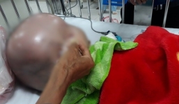 Bé trai bị não úng thủy đầu nặng 15 kg ở Thanh Hóa đã qua đời