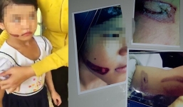 Vụ bé gái nghi bị dí sắt nung vào người: Tỷ lệ thương tật 12\%, công an khởi tố vụ án