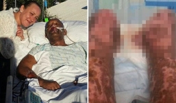 Vì vết xước chưa đến 1cm trên tay, người đàn ông phải cắt bỏ hai chân, chạy thận cả đời