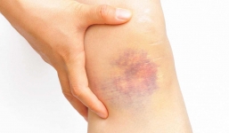 7 dấu hiệu cho thấy cơ thể đang thiếu hụt vitamin C cần bổ sung ngay lập tức