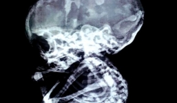 Thai nhi 4 tháng 'hóa đá' trong bụng mẹ suốt 15 năm