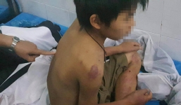 Bé trai 11 tuổi nghi bị bố đánh đa chấn thương