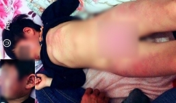 Bé gái 4 tuổi bầm tím toàn thân sau giờ học ở Bắc Giang: Bạn cùng lớp dùng gậy đồ chơi đánh