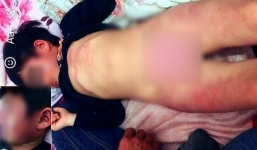 Công an Bắc Giang thông tin vụ việc bé 4 tuổi bị đánh bầm tím ở lớp