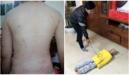 Bé trai 10 tuổi nghi bị bố và mẹ kế bạo hành gãy xương: Không được đi học, chỉ ăn mì tôm sống