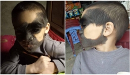 Số phận éo le của cậu bé 6 tuổi mang khuôn mặt dị thường hai màu trắng đen