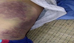 Kinh hoàng con trai đánh bố gãy xương sườn